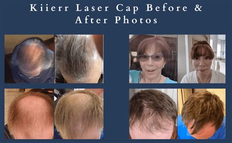 Laser Caps Vs. Hair Transplant Surgery? Which Should You Try First? - Kiierr Laser Hair Caps ...