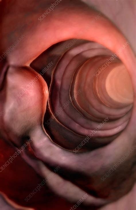 Duodenal cancer - Stock Image - F002/1695 - Science Photo Library