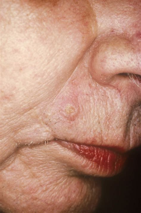 Trichilemmoma & desmoplastic trichilemmoma, causes, symptoms, diagnosis & treatment