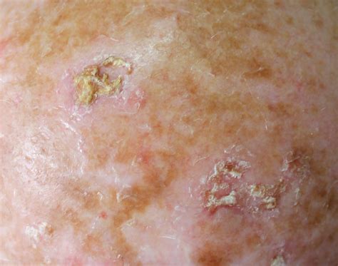 Managing Actinic Keratosis: An Expert Consensus - Dermatology Advisor