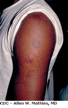 Viral Skin Infection: Herpes gladiatorum ("Mat Herpes")