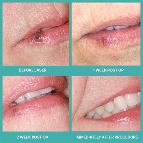 Venous Lakes Lip Laser Treatment in Phoenix, AZ - Atrium Dental