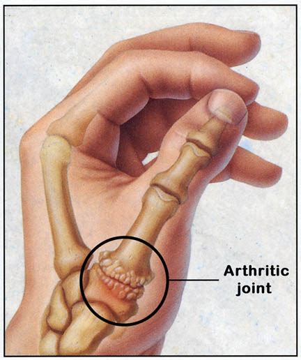 Hand: Basal Joint Arthritis – Decatur Orthopedica Center (IL)