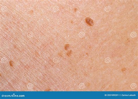 Papilloma Nevus Or Mole On Human Skin Stock Photo | CartoonDealer.com #162979872