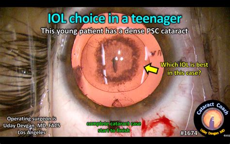 1674: IOL choice in a teenager – Cataract Coach™