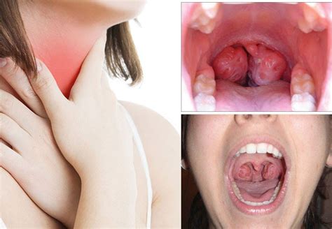 Tonsillitis causing an abscess around the tonsils | Vinmec