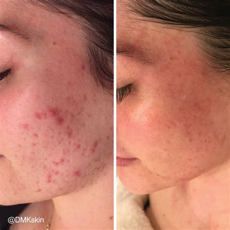 adapalene acne scars before after - Nicholas Watkins