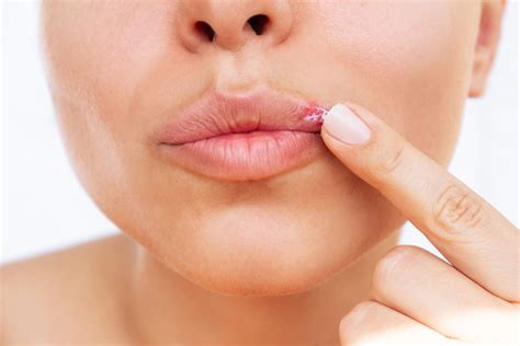 Herpes labial: Tratamiento y síntomas - Clínica Dental de Terrassa