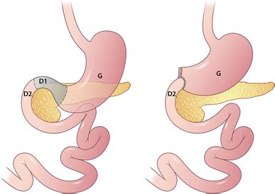 Gastroduodenal and pancreatic surgeries: indications, surgical techniques, and imaging features ...