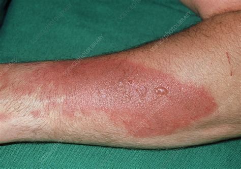 Close up: second degree burn to male left forearm - Stock Image - M335 ...