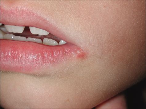 الهربس الفموي الحاد (Herpetic gingivostomatitis) – الدكتور هاشم المساوى ...