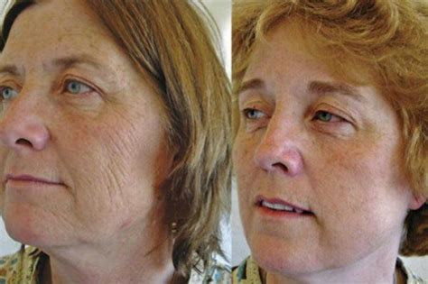 This Is What 7 Smoker vs. Non-Smoker Identical Twins Look Like After Years Of Lighting Up ...