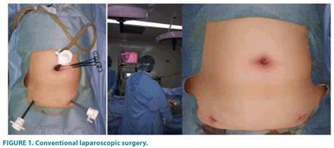 Surgery Incision