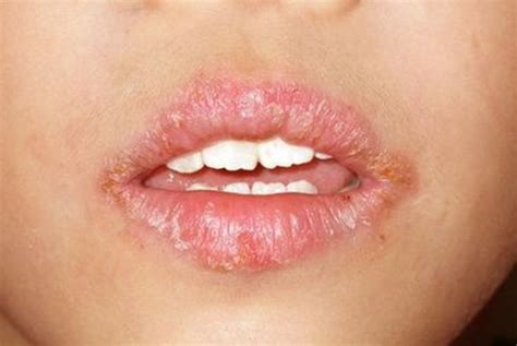 Angular Cheilitis - Photos