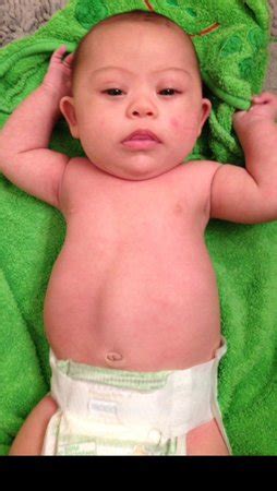 Does this look normal? Maybe a hernia? | BabyCenter