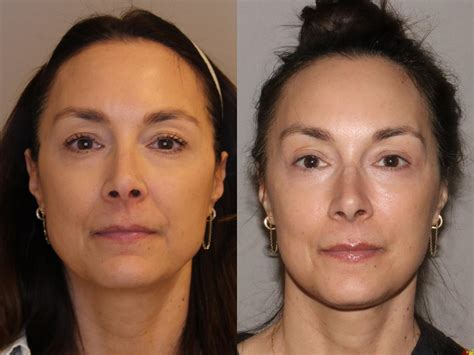 Restylane CONTOUR Before and After Photo Gallery | Atlanta, Georgia ...