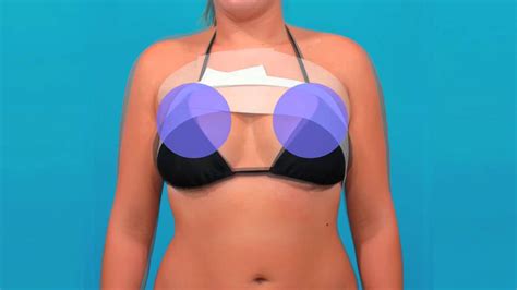 How Long To Wear Ace Bandage After Breast Augmentation? Update - Achievetampabay.org