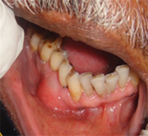 Lateral Periodontal Cyst Histology