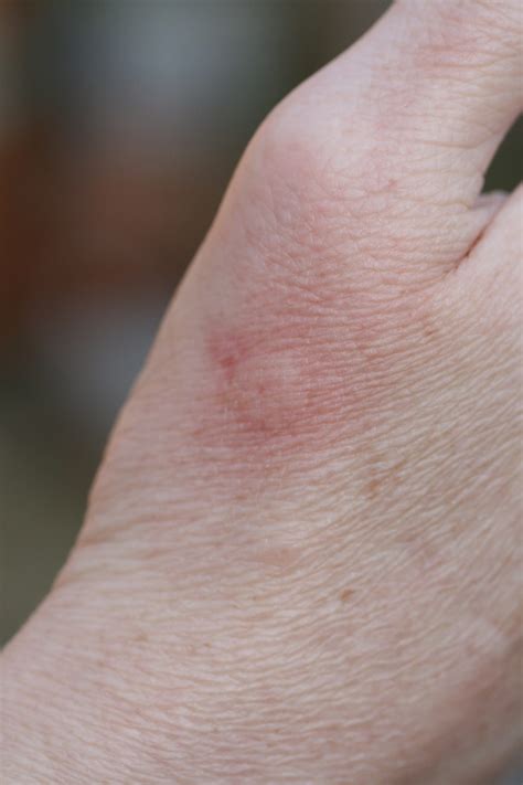 11 WAYS TO PREVENT AND TREAT STINGS - Rapid Pest Solutions