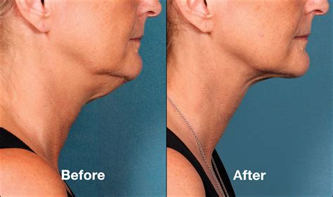 BELKYRA® (KYBELLA) in London, Ontario | DermEffects