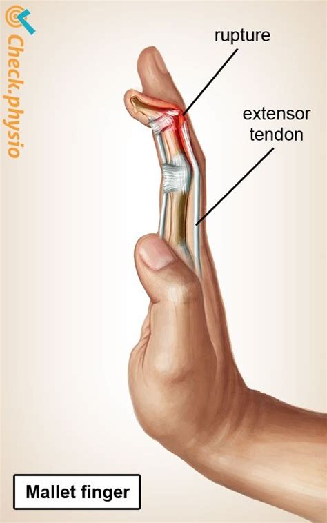 2018-08-21 - In the case of mallet finger, the tendon that extends the tip of the finger i ...