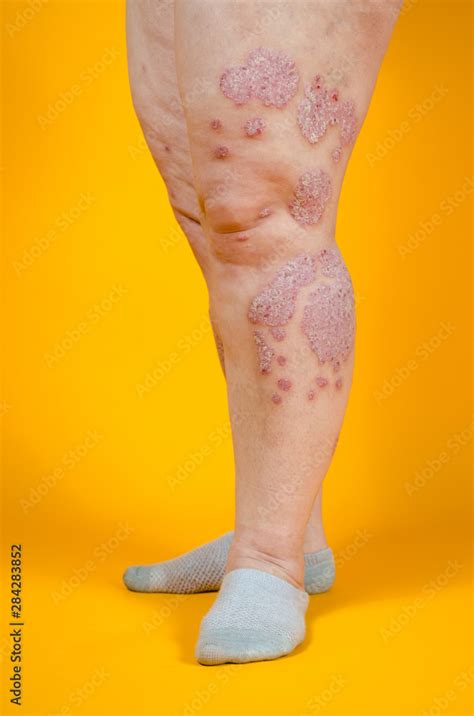 Dermatological skin disease. psoriasis, eczema, dermatitis, allergies. Skin lesions on the legs ...