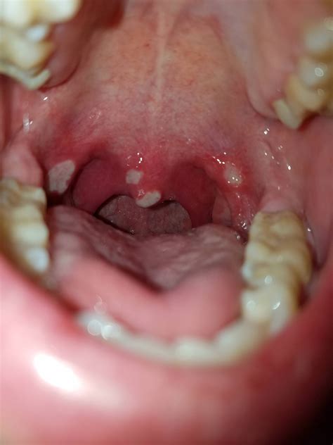 Unbearable canker sores coating my throat and mouth. (I even have them on my uvula) : r/AskDocs