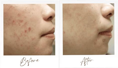 Acne Treatment - Dr Abby Clinic | #1 Best Reviewed Aesthetic Clinic