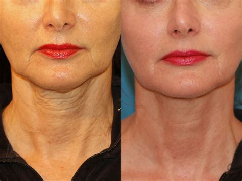 Sculptra injection – a long-acting filler - Hush LA Medspa