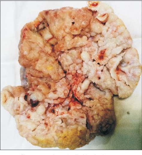 Figure 4 from Radical vulvectomy with inguinal lymph node dissection ...