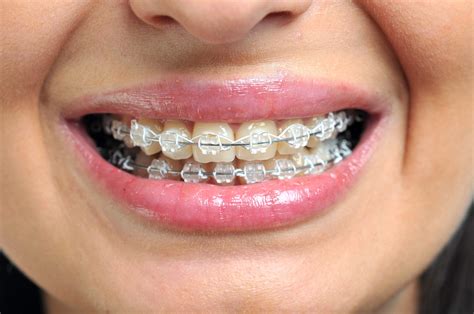 Understanding Metal Braces for Orthodontic Treatment