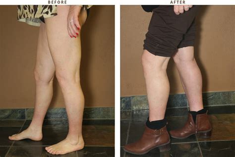 Calf Augmentation – Before and After Pictures * | Dr Turowski - Plastic Surgery Chicago