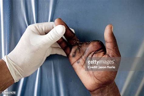 98 Severed Fingers Stock Photos, High-Res Pictures, and Images - Getty Images