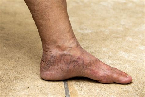 Understanding Varicose Veins in the Feet | Vein Institute Of Pinellas