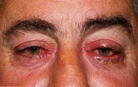 Ocular Rosacea - Causes, Triggers, Symptoms, Eye Drops, Treatment