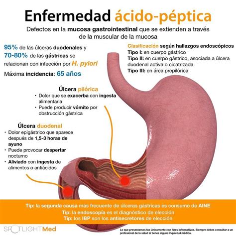 Enfermedad ácido-péptica 🤮 #SpotlightMed #Spotlight #Spotlightmedicine ...