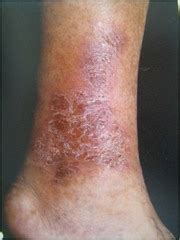 Venous Stasis Dermatitis - Florida Vein Care Specialists