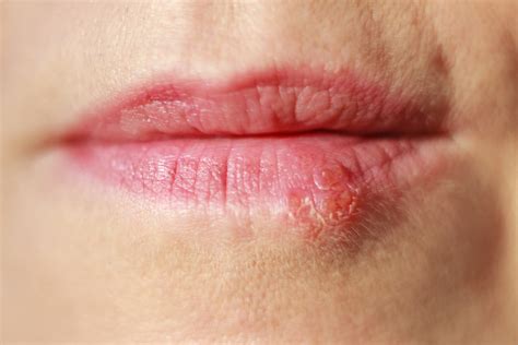 Mouth ulcers and cold sores: What’s the difference?