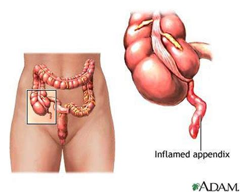 Pictures Of Appendix