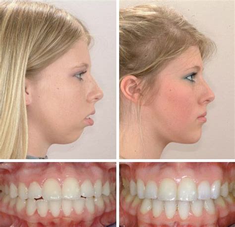 Braces Jaw Overbite Before And After | Before And After