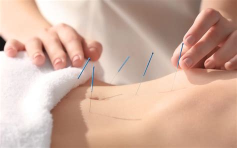 Acupuncture For Lower Back Pain Treatment - LiveWell Health and Physiotherapy