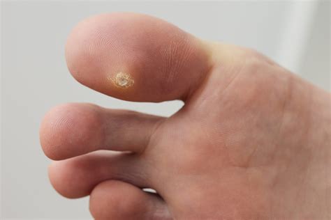 Plantar Wart and Verrucae Removal Specialist