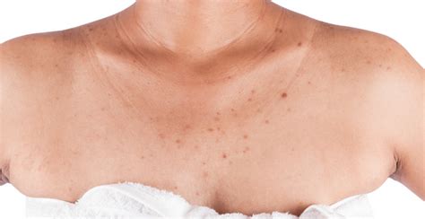 Chest Acne: Causes, Treatments, and Prevention | Clinikally