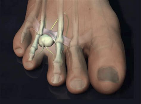 Morton's Neuroma - Symptoms, Causes And Other Risk Factors