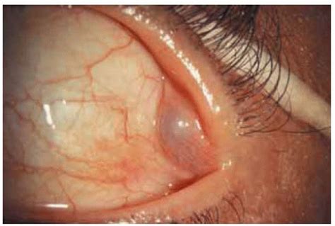 Lacrimal Duct Cyst