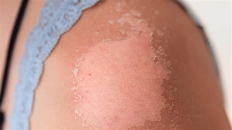 Here are the possible causes and home remedies for peeling skin ...