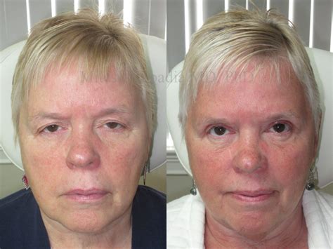 Before And After Eyelid Retraction Surgery Photos Aes - vrogue.co