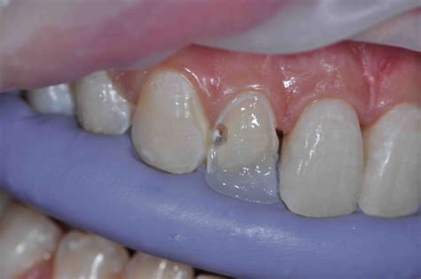 Layering Composite For Esthetics - Lee Ann Brady DMD