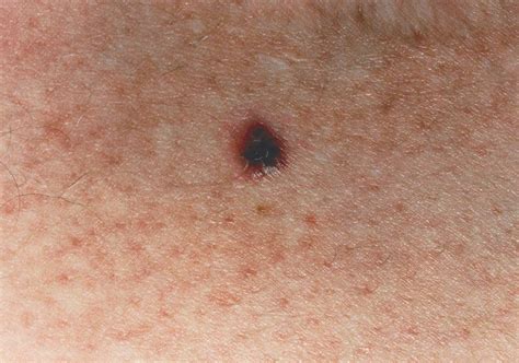 Melanoma Skin Cancer Stages