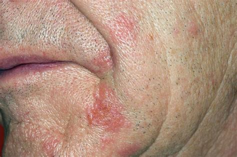 Shingles Rash On The Face Photograph by Dr P. Marazzi/science Photo Library